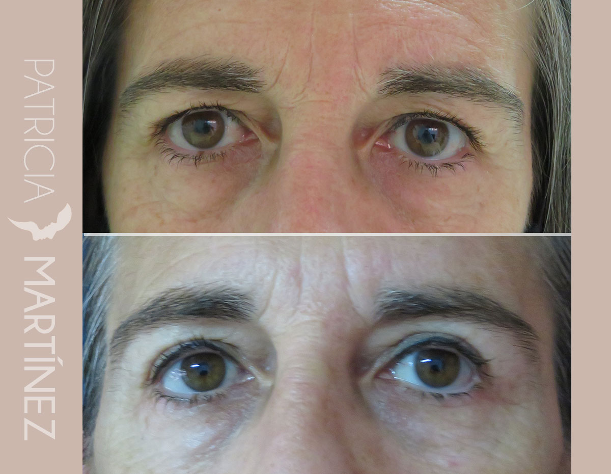 antes-despues-blefaroplastia-11