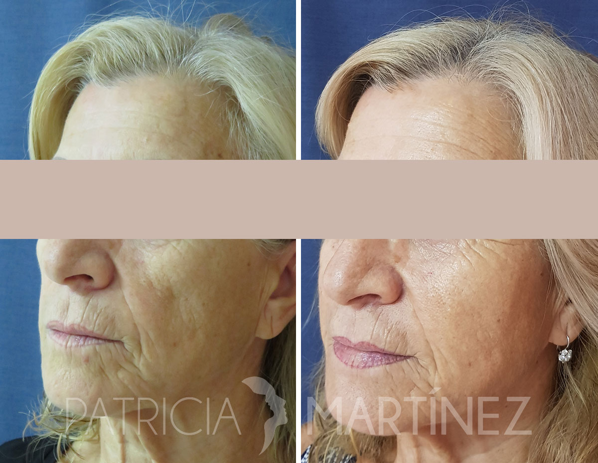 antes-despues-lipofilling-03