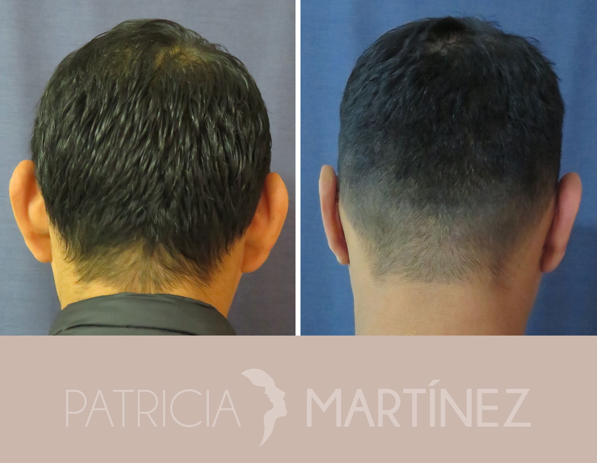 antes-despues-otoplastia-05