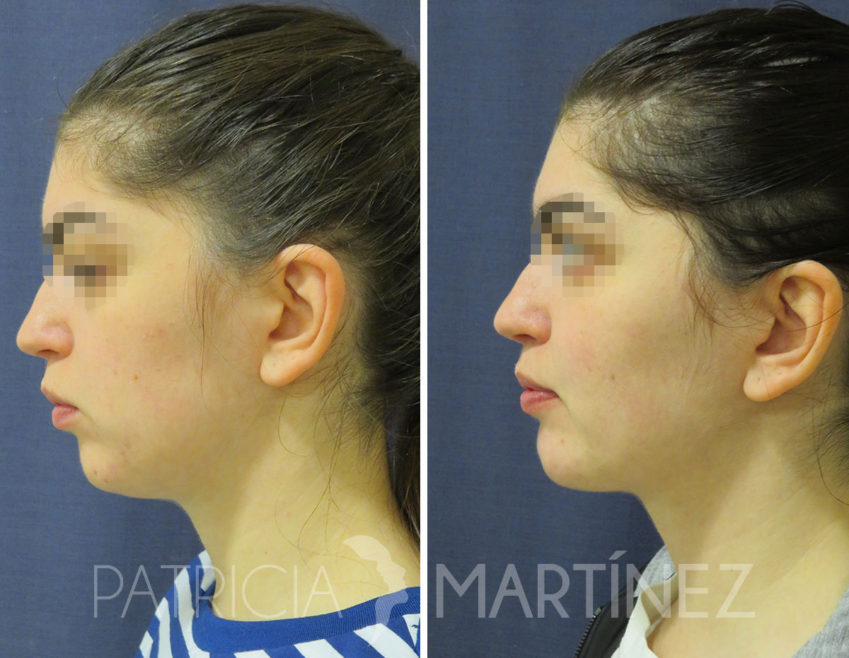 antes-despues-perfiloplastia-04b