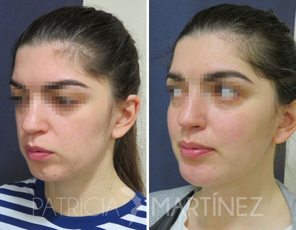 antes-despues-perfiloplastia-05b