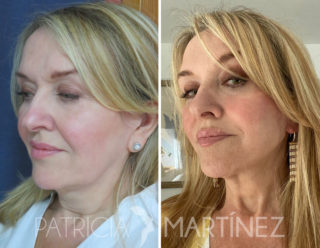 lifting facial deep plane cervicofacial lift