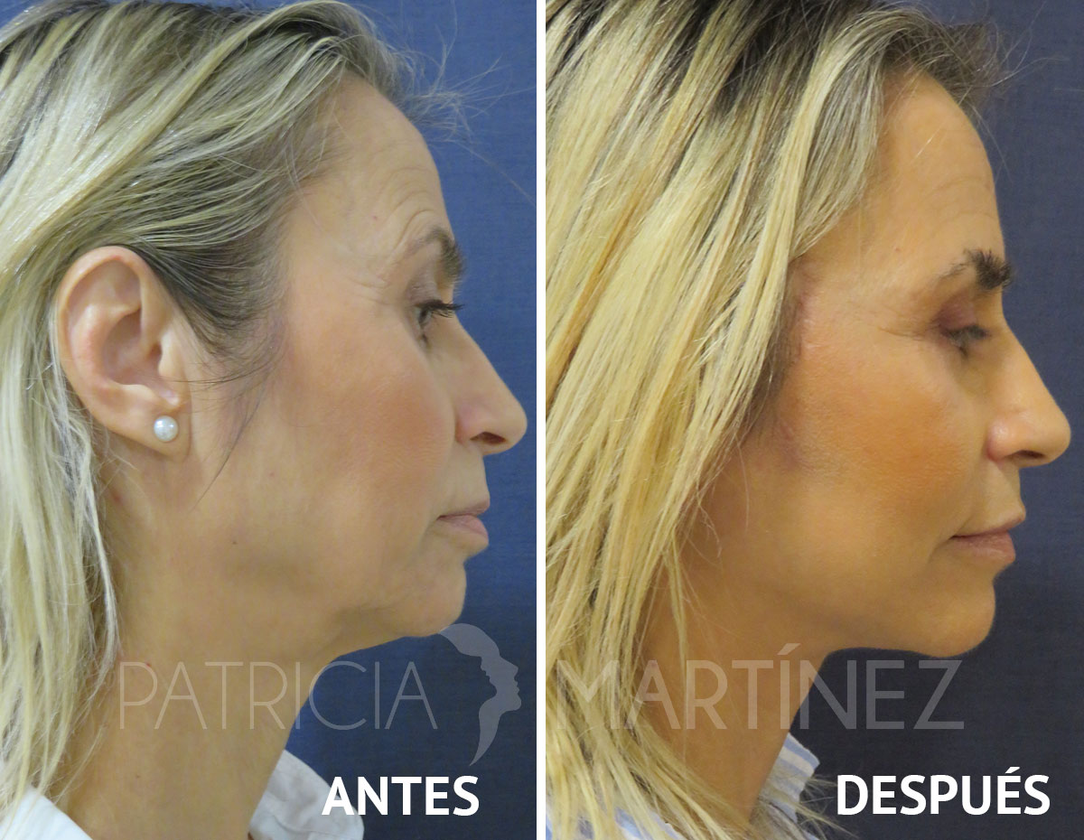 lifting210624-3