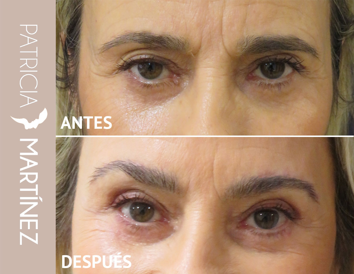lifting-cejas-01