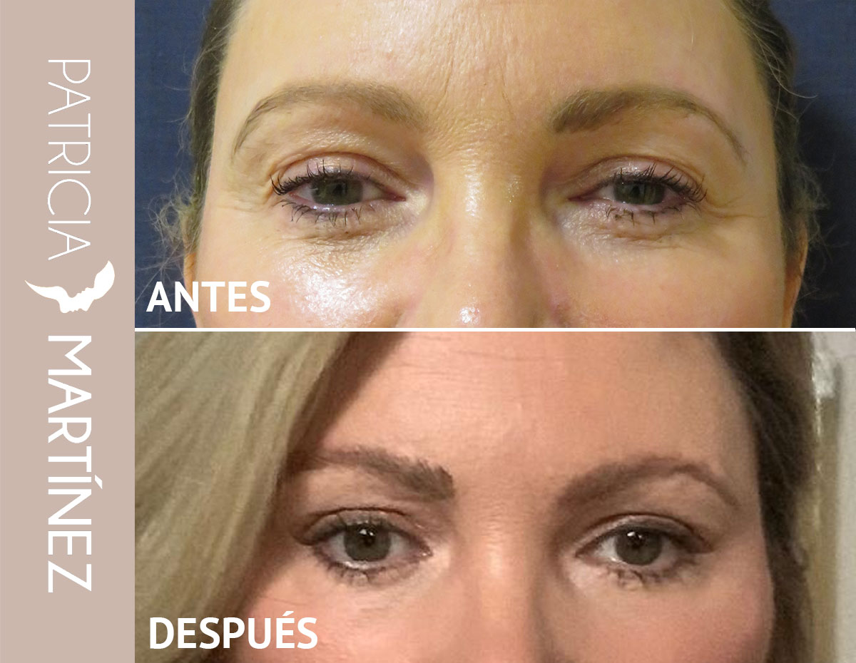 lifting-cejas-02