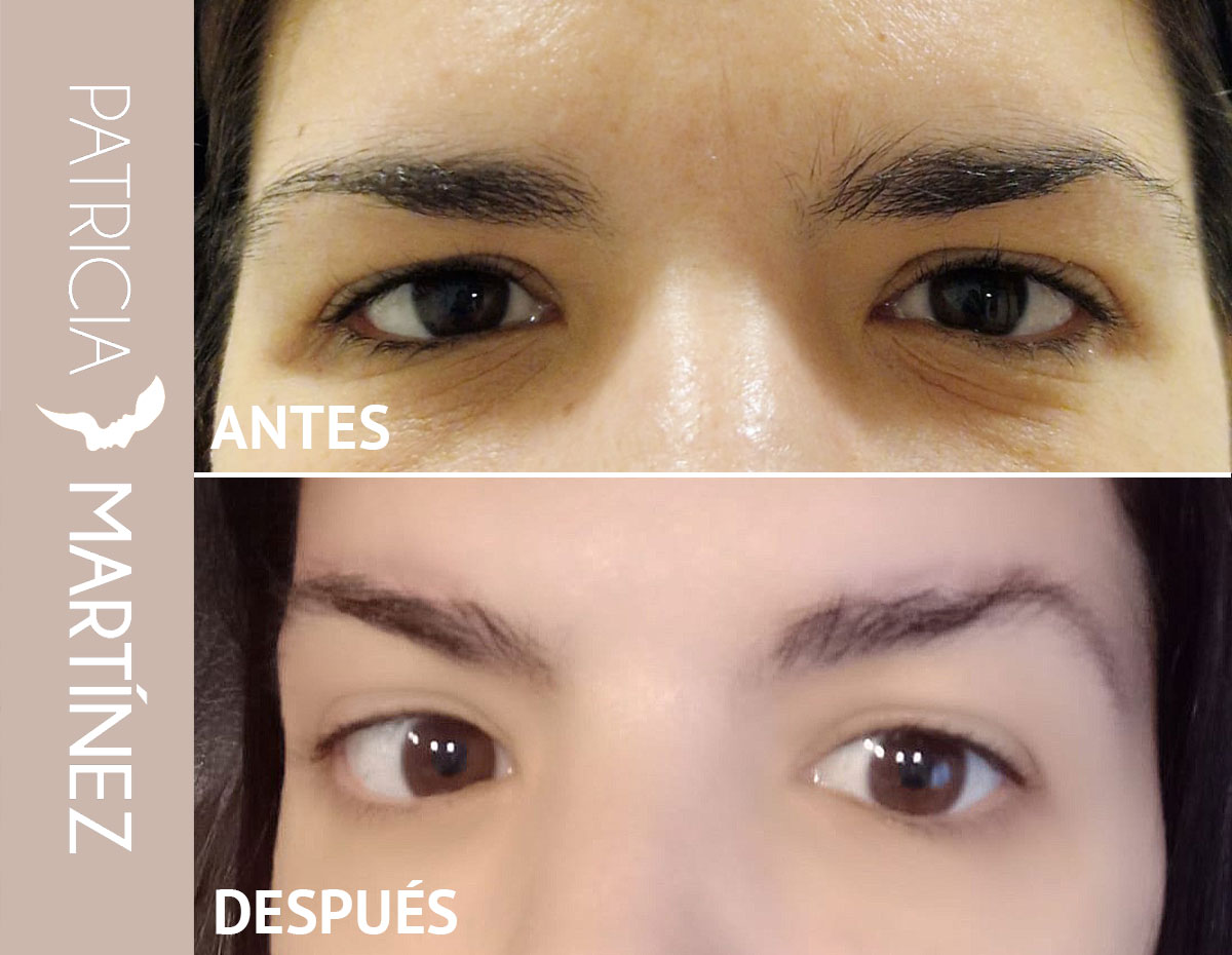 lifting-cejas-03
