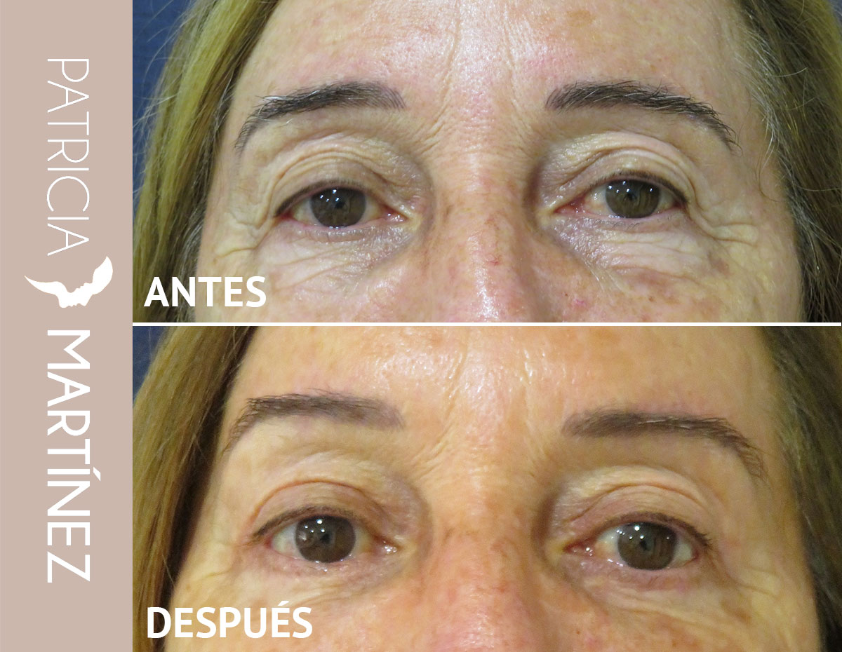 lifting-cejas-04