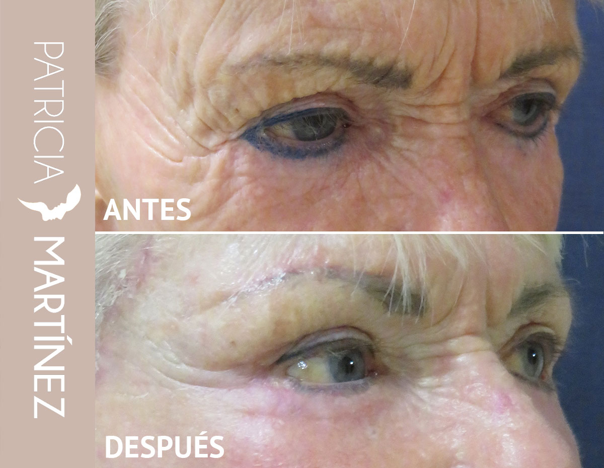 lifting-cejas-05