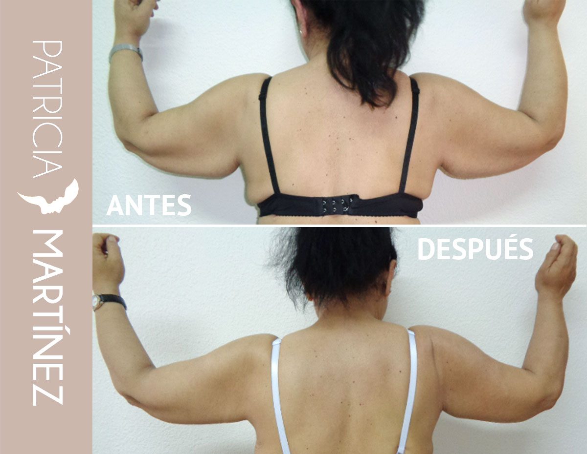 lifting-brazos-04